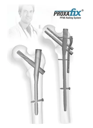 Profix-Nailing-sytem