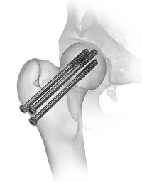Cannulated Screws