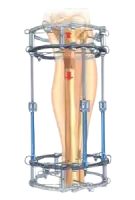 external fixation system